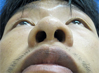nose_3_m30_l_before_2